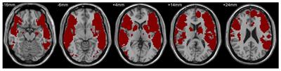 The Relationship between Intrinsic Couplings of the Visual Word Form Area with Spoken Language Network and Reading Ability in Children and Adults